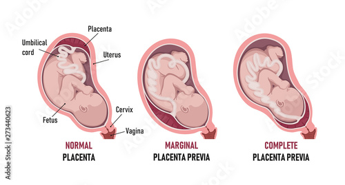 Placenta previa: normal , Partial, Marginal (Low-lying), Complete