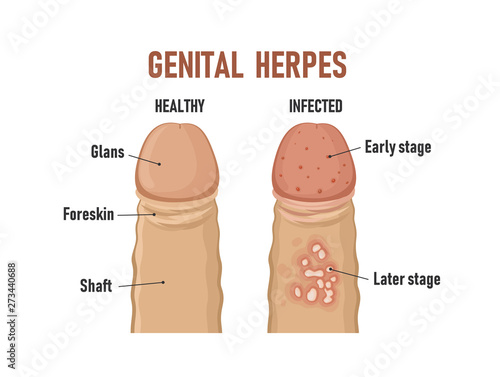 Foto Genital herpes. Healthy penis and infected