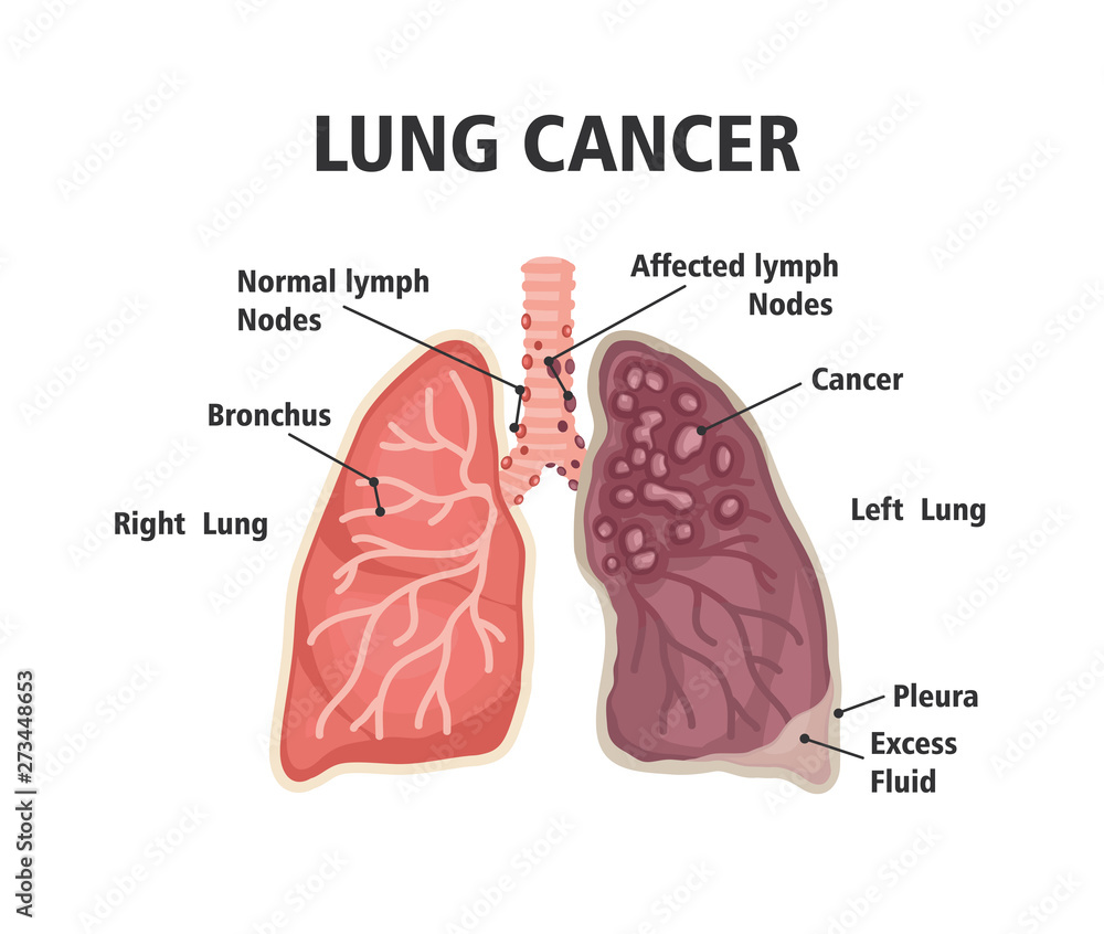 Comparison between healthy lung and cancer lung Stock Vector | Adobe Stock