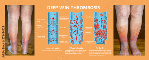 Close-up of skin with varicose veins