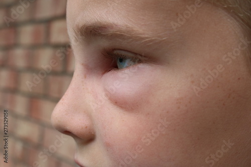 Εκτύπωση καμβά Profile picture of a young boy with swelling of face due to hornet sting