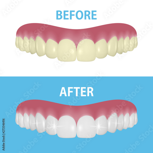 Vector Background with 3d Realistic Render Denture Set Closeup Isolated. Dentistry and Orthodontics Design. Human Teeth for Medical and Toothpaste Concept. Healthy Oral Hygiene, Jaw Prosthesis