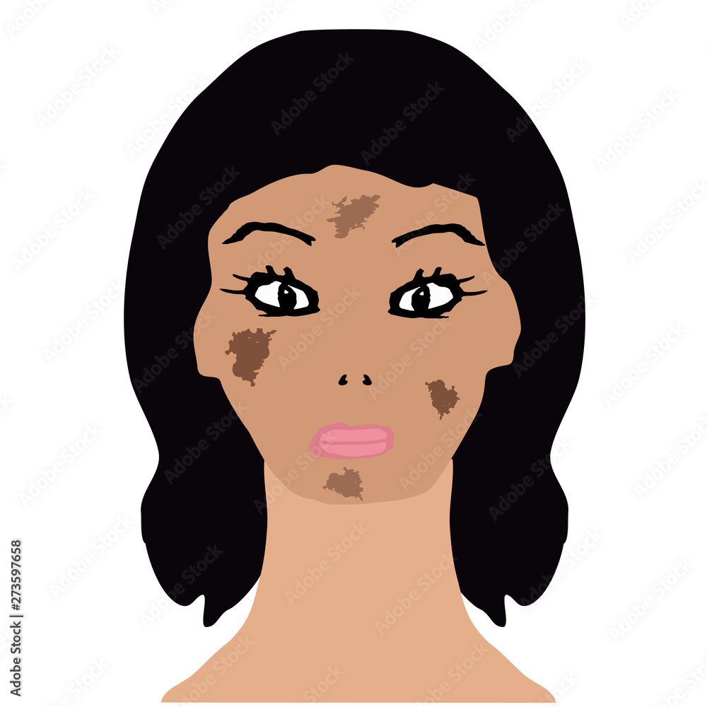 Face with pigmentation. Brown spots on the skin. Infographics. Vector illustration on isolated background. Face with pigmentation. Brown spots on the skin. Infographics. Vector illustration on isolated background.