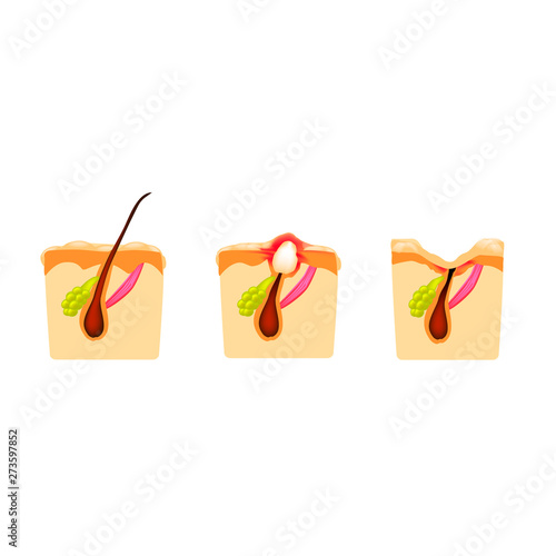 open comedones, inflamed acne, cysts. Inflamed pimples. The structure of the skin. Scar acne and pimples. Infographics. Vector illustration on isolated background.