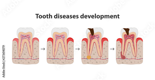 Development of tooth disease medical poster illustration in flat design. Teeth in gum icons isolated on white background.