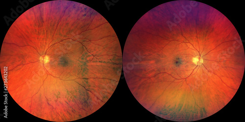 Photograph of the Fundus Oculi