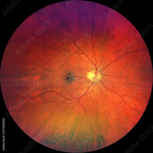 Photograph of the Fundus Oculi