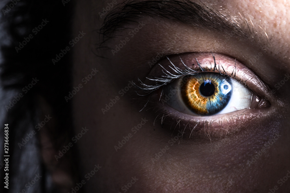 Human with heterochromia iridium in an eye