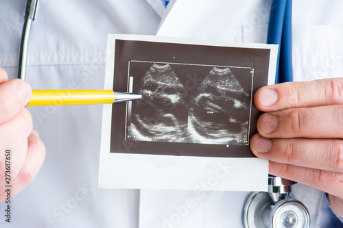 Принти на полотні Pericarditis on ultrasound image of heart concept photo
