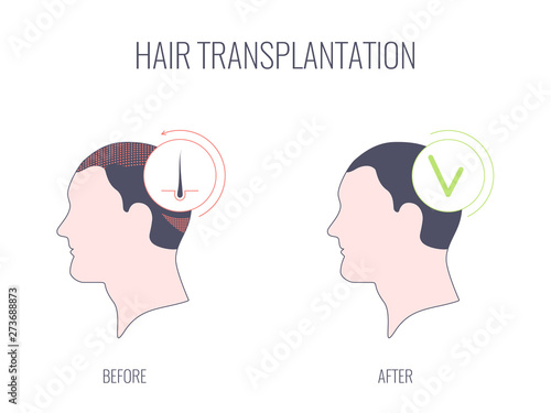 Hair transplantation procedure. Hair loss medical treatment of a male patient with alopecia. Faceless man, no identity concept. Before and after concept. Vector linear illustration for clinics.