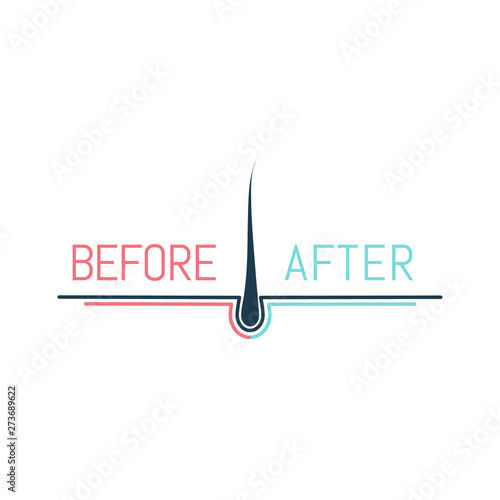 Hair transplant logo with a follicle icon for medical diagnostic centers and clinics. Before and after concept. Alopecia and baldness treatment outcome.