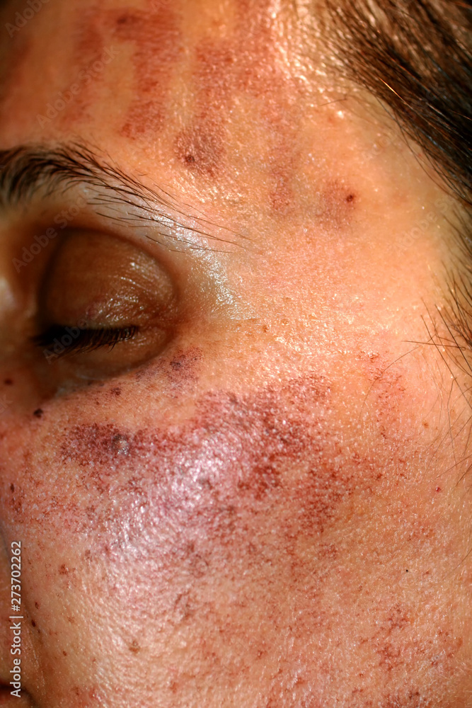Pigmented spots on the face. Pigmentation on cheeks Pigmented spots on the face. Pigmentation on cheeks