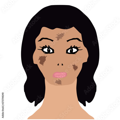 Face with pigmentation. Brown spots on the skin. Infographics. Vector illustration on isolated background.