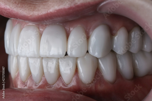 aesthetic ceramic crowns final patient surrender and beautiful photo