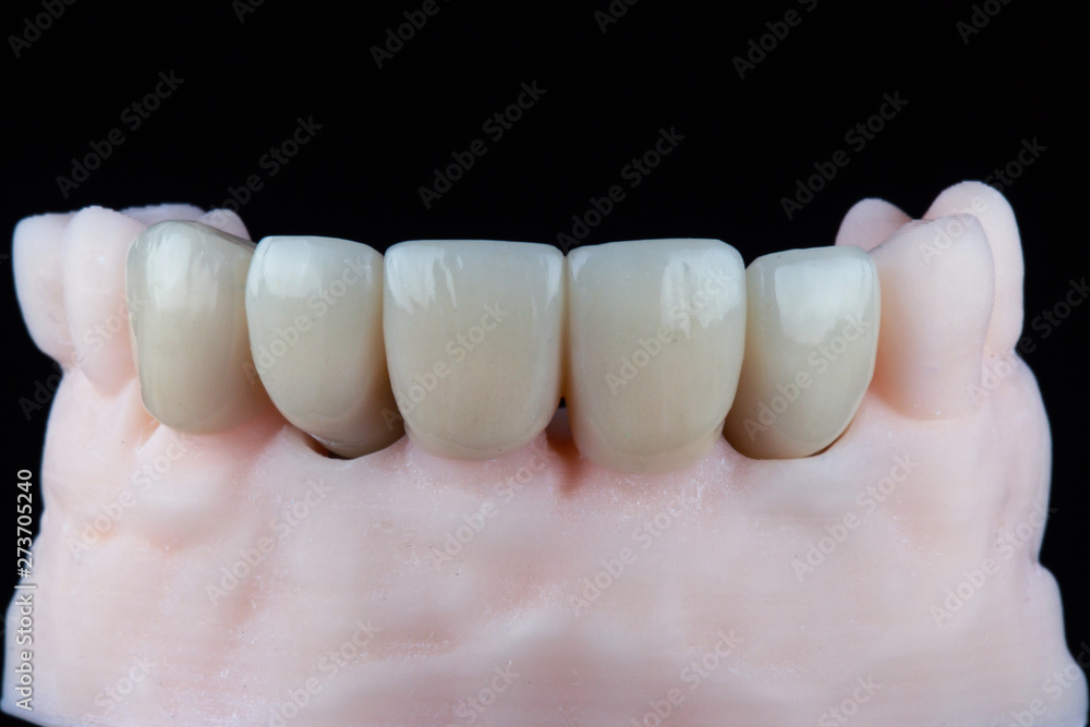 dental crowns for the front teeth on the model from the front