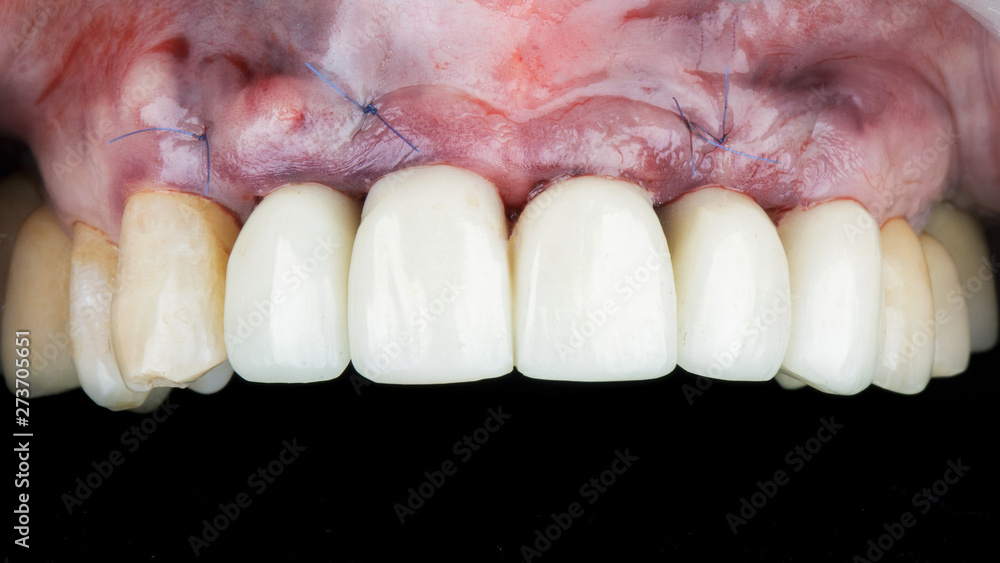 gum after installing two implants and crowns in the part of the front teeth