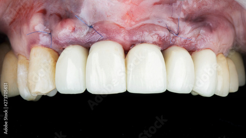 gum after installing two implants and crowns in the part of the front teeth