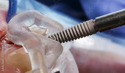 implant insertion through a surgical dental template during surgery