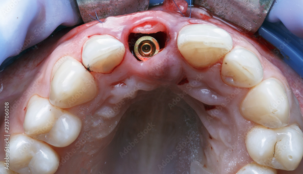 Obraz premium implant in the gum cavity of the anterior incisor, special dental photo