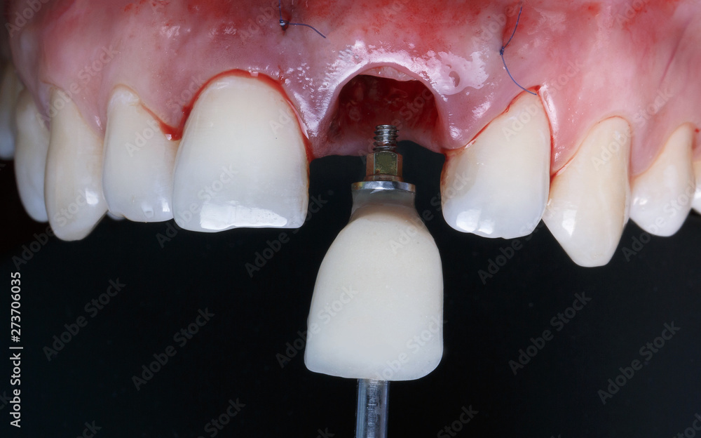 installation of a special crown in the frontal part and added soft tissue in the patient's gum