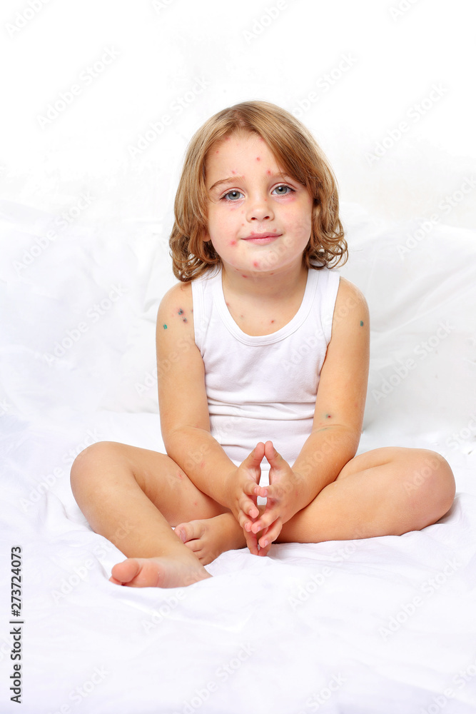 Chickenpox in a 3 year old boy. Portrait, long hair, white clothes, background