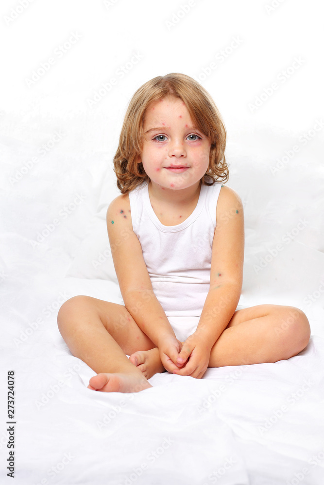 Chickenpox in a 3 year old boy. Portrait, long hair, white clothes, background Chickenpox in a 3 year old boy. Portrait, long hair, white clothes, background