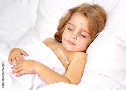 Chickenpox in a 3 year old boy lying in bed. Portrait, long hair, white clothes, background