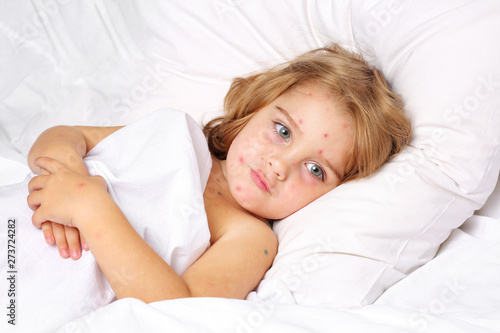 Fotografie Chickenpox in a 3 year old boy lying in bed