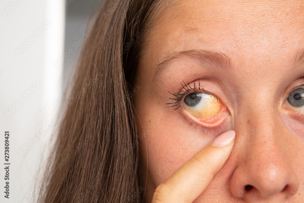 Woman showing symptoms of jaundice in the eyes Stock Photo Adobe Stock