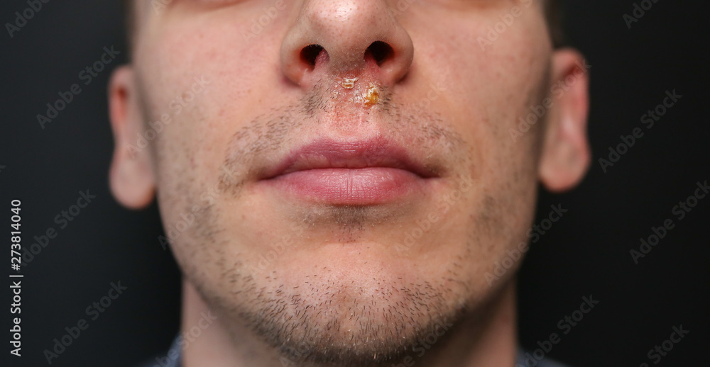 Herpes virus under the nose. Cold sore after the flu. Medical photo. Disease treatment. Herpes virus under the nose. Cold sore after the flu. Medical photo. Disease treatment.