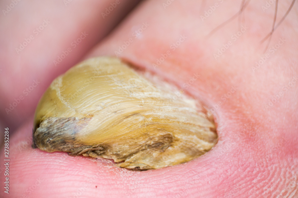 Fototapeta premium Macro photo of a human toenail with fungus