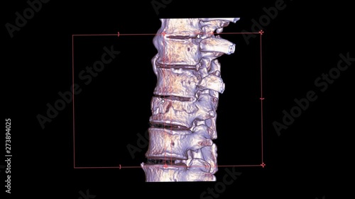CT Scan of T-L spine or thoracolumbar junction spine 3D rendering image turn around on the screen showing fracture L1 spine. photo
