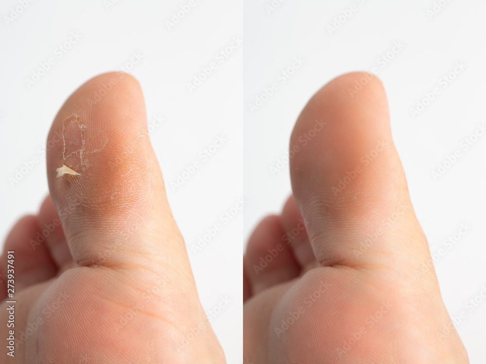 A closeup view of callus skin on the big toe of a Caucasian person, before and after view isolated against a white background. A closeup view of callus skin on the big toe of a Caucasian person, before and after view isolated against a white background.