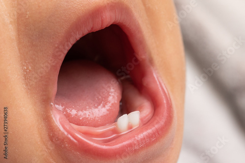 The mouth of a screaming infant is viewed close up, revealing baby teeth in the bottom gum. Childhood dentistry concept.