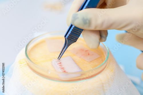 Hair follicles in the Cup close-up. Baldness treatment. Hair transplant. Surgeons in the operating room carry out hair transplant surgery. Surgical technique that moves hair follicles from a part of