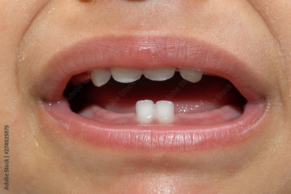 Fototapeta premium A closeup view on the mouth of a preschool child, showing four milk teeth in the top gum and two incisors in the bottom gum. Childhood dentistry concept.