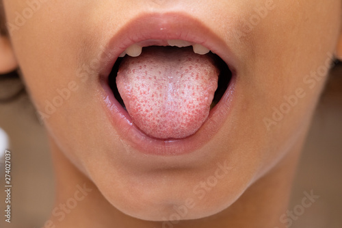 A closeup and front on the mouth view of a young child under 10 years old, sticking their spotty tongue out with missing milk teeth.