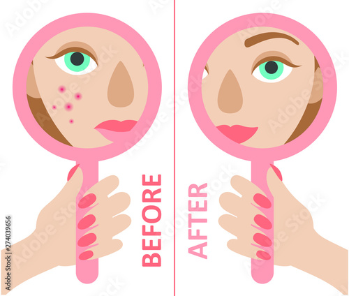 A hand holding a mirror reflecting the face of a young girl with acne and without. Flat vector on white background