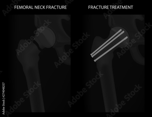 Vector illustration hip joint problem, x-ray of femoral neck fracture treatment with three big screws. For advertising and medical publications.