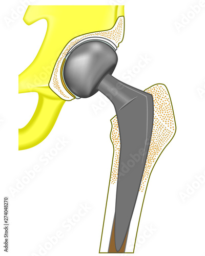 Vector illustration hemiarthroplasty of the hip joint. For advertisement and medical publications.