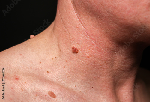 Big birthmark on the man's skin. Medical health photo. Papillomas on the neck. photo