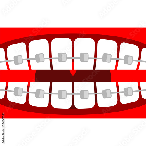 Braces on teeth. Open mouth and tooth