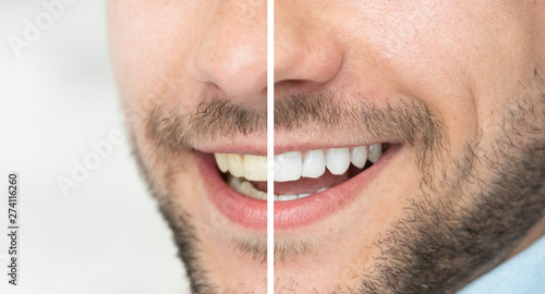 Dental care and whitening teeth compare