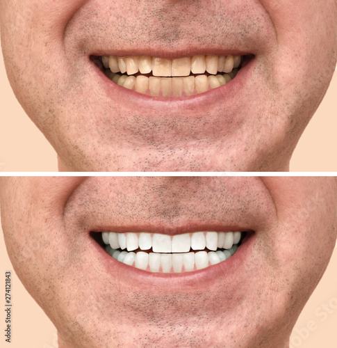 Teeth of a man before and after dental treatment