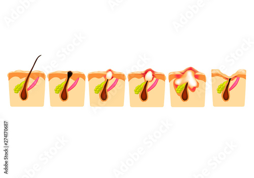 Types of acne. Closed comedones, open comedones, inflamed acne, cysts. Inflamed pimples. The structure of the skin. Scar acne and pimples. Infographics. Vector illustration on isolated background.