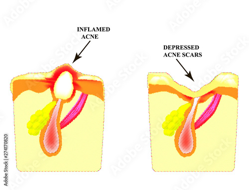 Inflamed acne on the skin. Inflamed pimple. The structure of the skin. Acne scar.