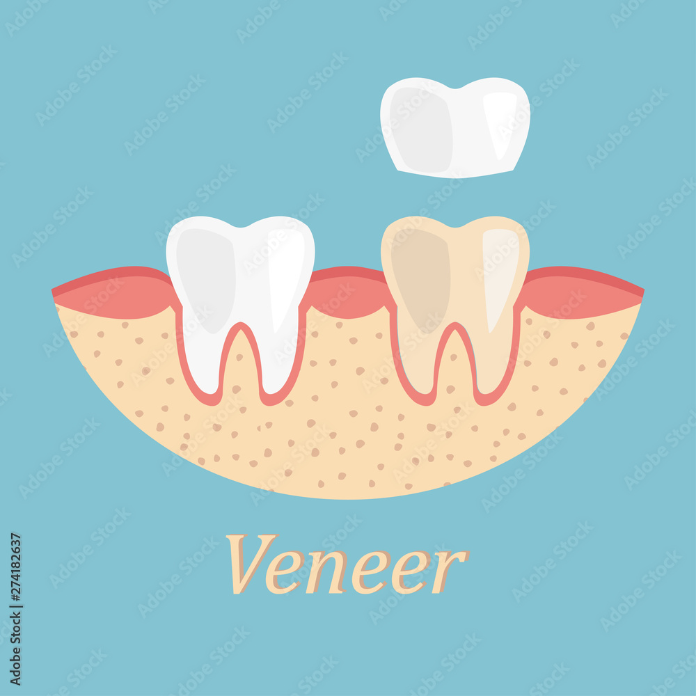 Teeth procedure of veneer restoration. Process stomatology prosthesis Teeth procedure of veneer restoration. Process stomatology prosthesis