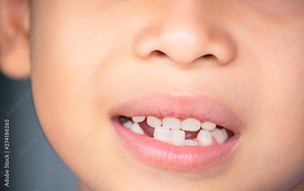 Obraz premium Baby teeth are just dropped in the mouth and regenerate tooth.