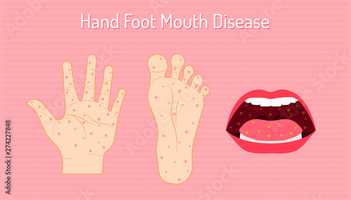 hand foot mouth disease. enteroviruses or EV71 is name of virus. be careful of your chidren and yourself. beautiful color background. vector illustration eps10