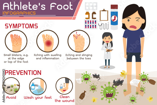 Athlete’s foot or Hong kong foot Disease Infographics. wounds on foot. symptoms and prevention Athlete's foot. health and medicine cartoon vector illustration.